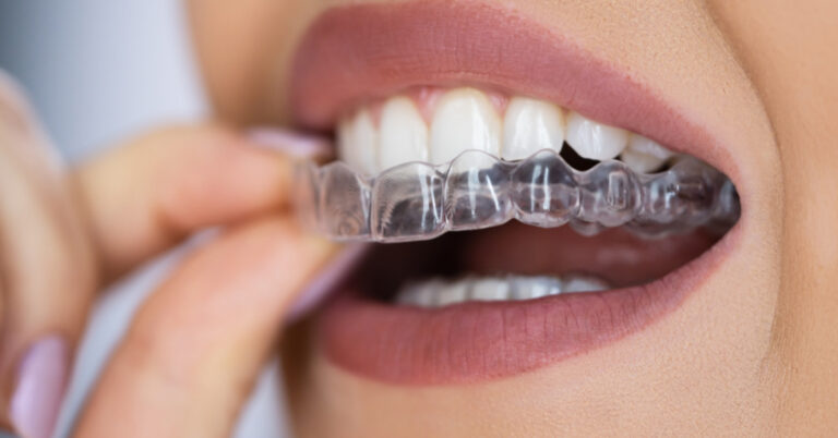 invisalign em itapema