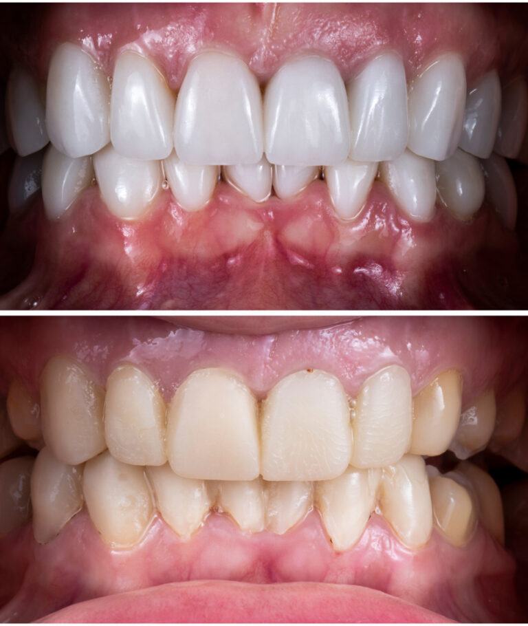 Facetas de Porcelana em Itapema faceta de porcelana antes e depois
