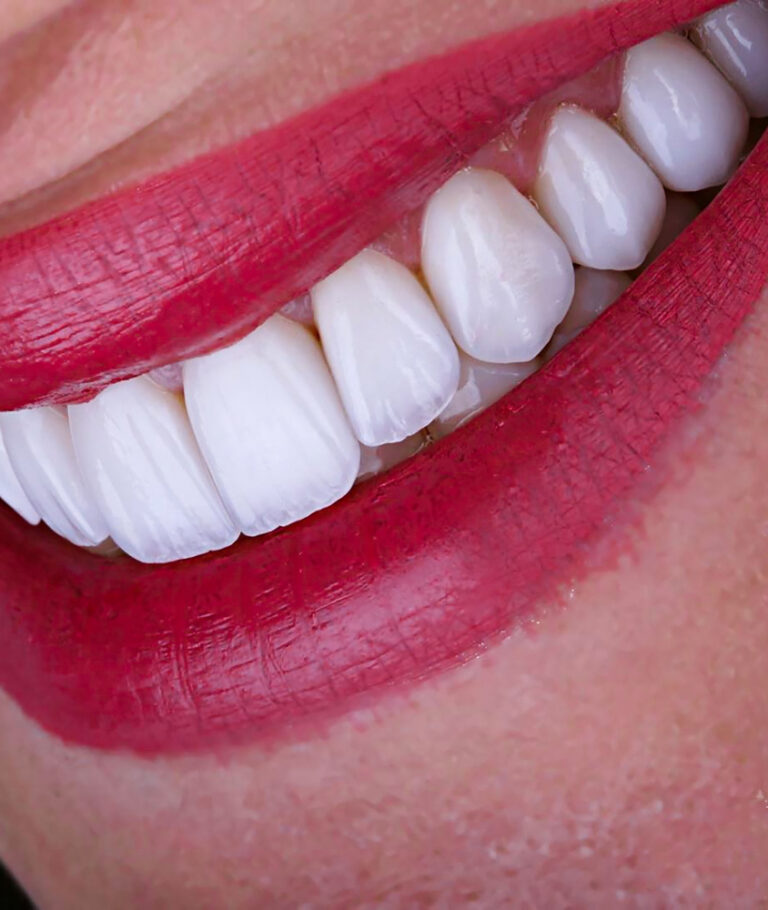 Facetas de Porcelana em Itapema o que e faceta de porcelana